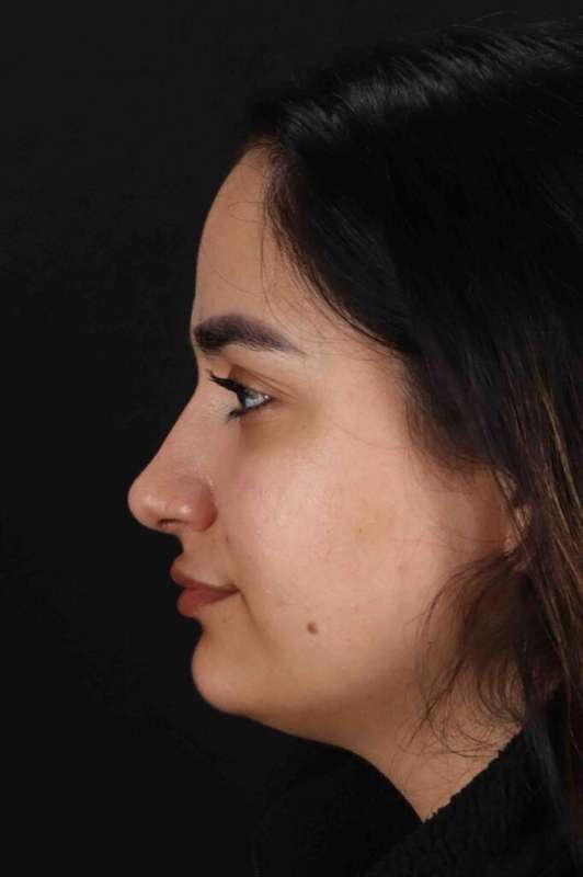 Rhinoplasty Before & After Patient #3071