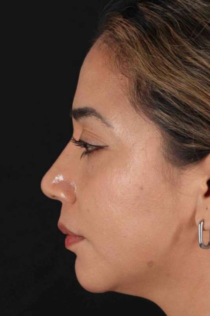 Rhinoplasty Before & After Patient #3082