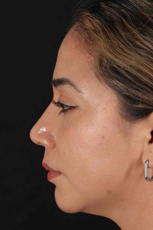 Rhinoplasty Before & After Patient #3082