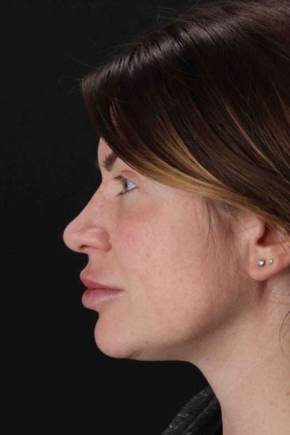 Rhinoplasty Before & After Patient #3093