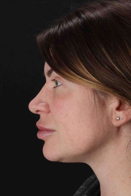 Rhinoplasty Before & After Patient #3093