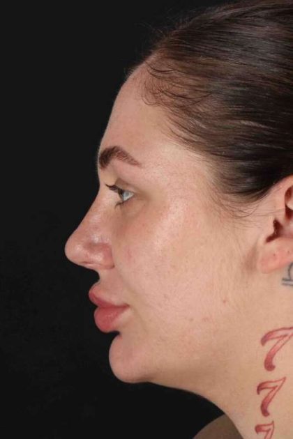 Rhinoplasty Before & After Patient #3104