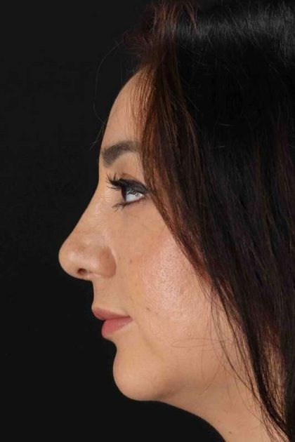 Rhinoplasty Before & After Patient #3115