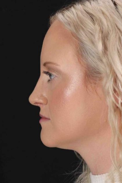 Rhinoplasty Before & After Patient #3126