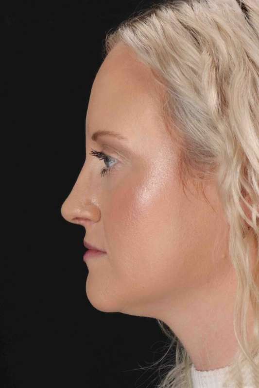 Rhinoplasty Before & After Patient #3126