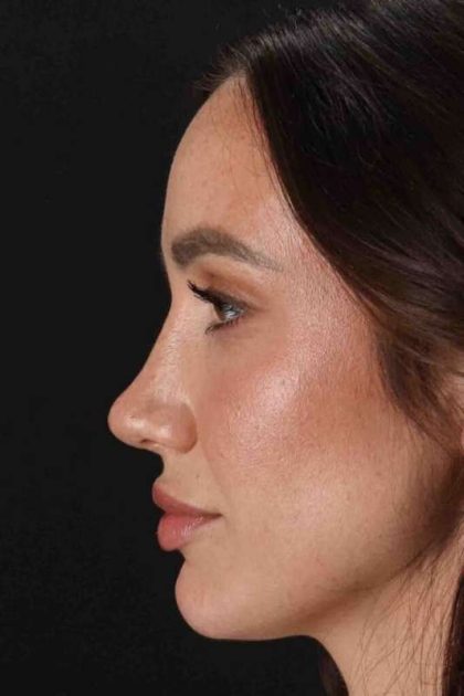 Rhinoplasty Before & After Patient #3137