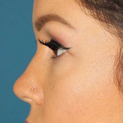 Browlift Before & After Patient #1384