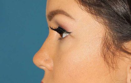 Browlift Before & After Patient #1384