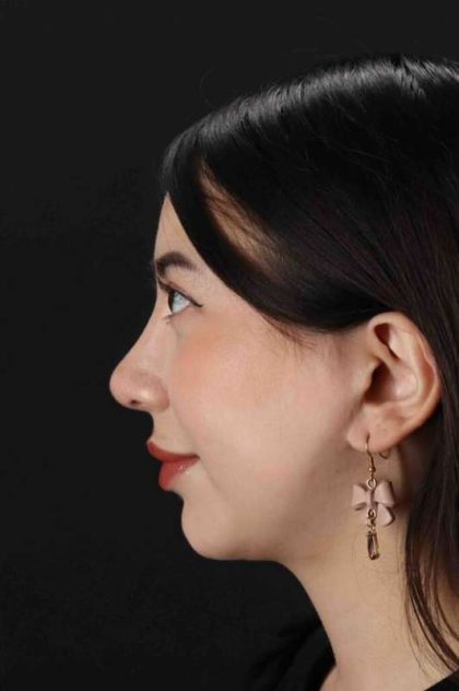 Rhinoplasty Before & After Patient #3159