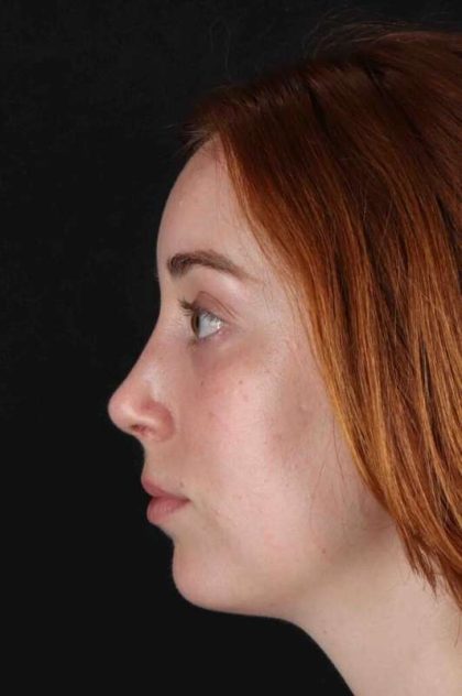 Rhinoplasty Before & After Patient #3170