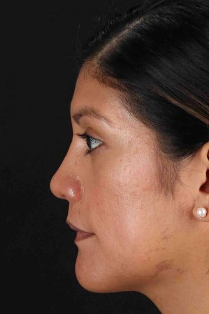 Rhinoplasty Before & After Patient #3181
