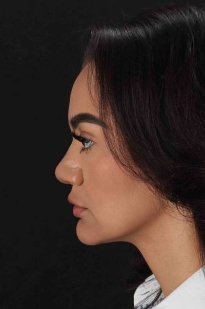 Rhinoplasty Before & After Patient #3192