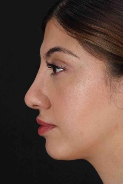 Rhinoplasty Before & After Patient #3214