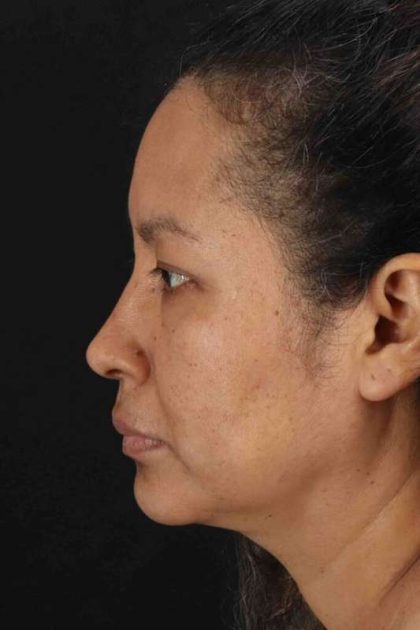 Rhinoplasty Before & After Patient #3225