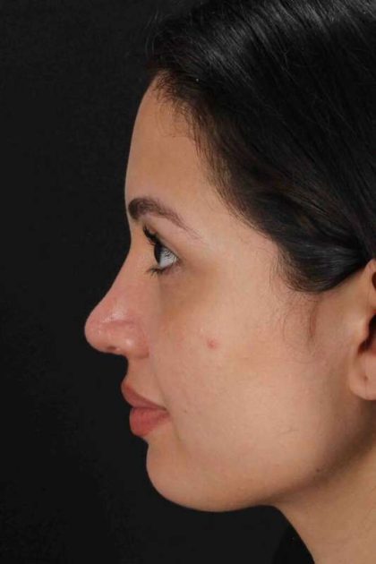 Rhinoplasty Before & After Patient #3236