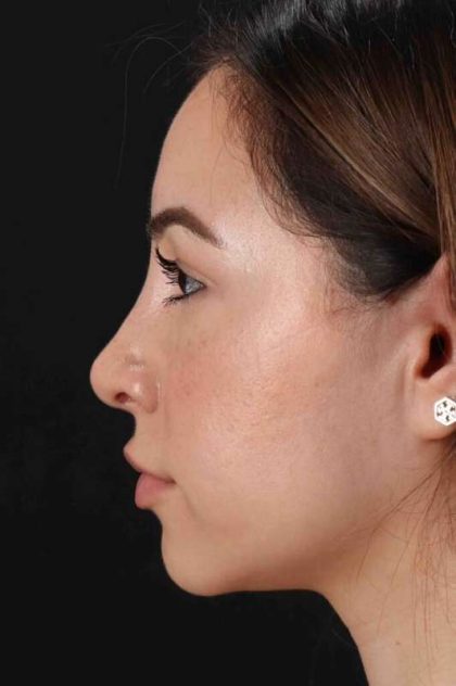 Rhinoplasty Before & After Patient #3247