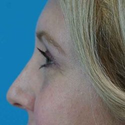 Browlift Before & After Patient #1402