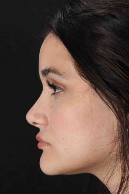 Rhinoplasty Before & After Patient #3258