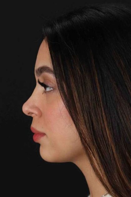 Rhinoplasty Before & After Patient #3269