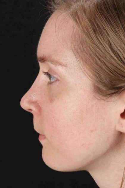 Rhinoplasty Before & After Patient #3280