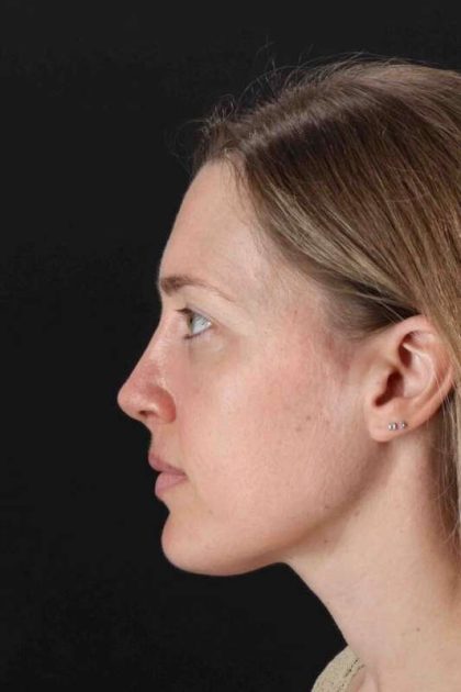 Rhinoplasty Before & After Patient #3291