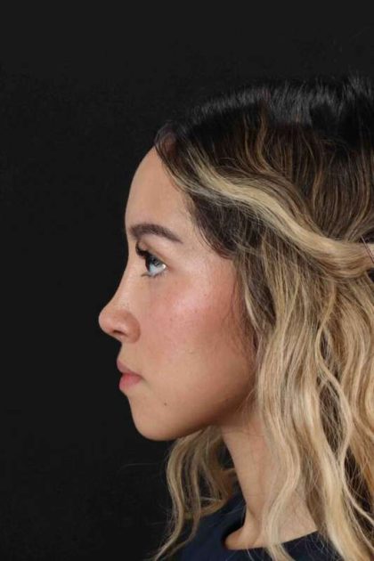 Rhinoplasty Before & After Patient #3302