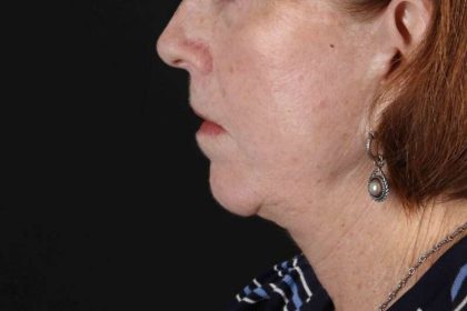 Submental Liposuction Before & After Patient #3401