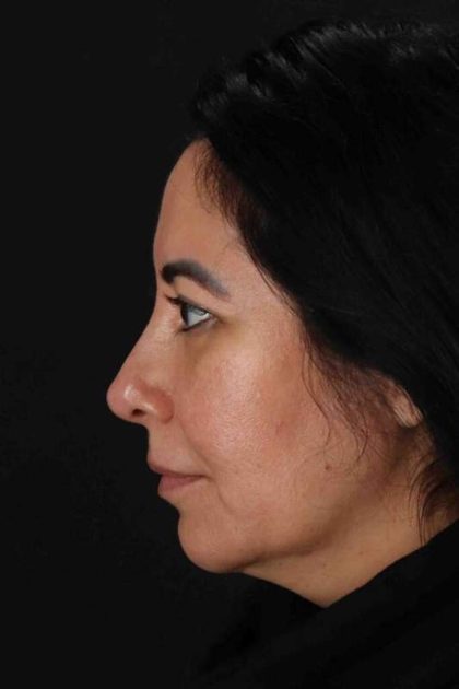 Upper Blepharoplasty Before & After Patient #3456