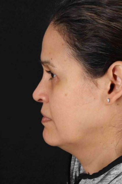 Upper Blepharoplasty Before & After Patient #3511