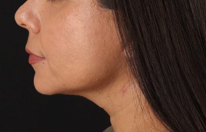Facelift Before & After Patient #3555