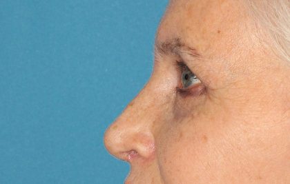 Upper Blepharoplasty Before & After Patient #3532