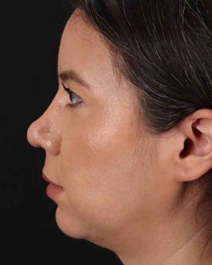 Buccal Fat Pad Before & After Patient #1458
