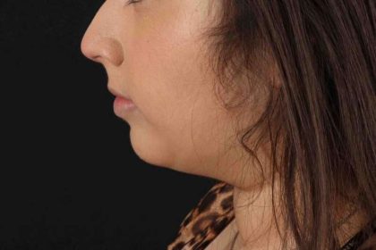 Buccal Fat Pad Before & After Patient #1469