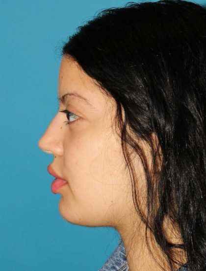 Buccal Fat Pad Before & After Patient #1485
