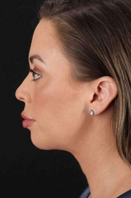 Chin Implant Before & After Patient #1518