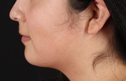 Chin Implant Before & After Patient #1529