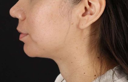 Chin Implant Before & After Patient #1540