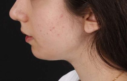 Chin Implant Before & After Patient #1551