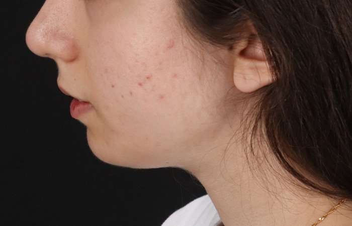 Chin Implant Before & After Patient #1551