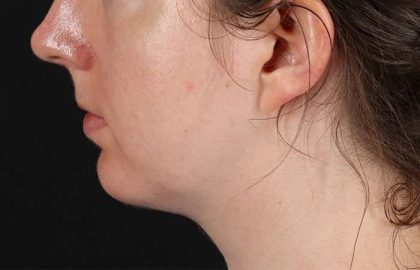 Chin Implant Before & After Patient #1562