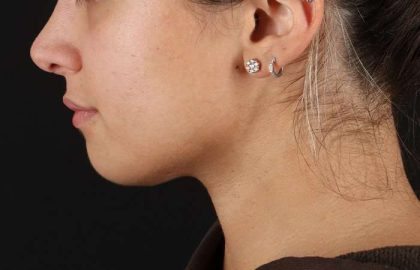 Chin Implant Before & After Patient #1573