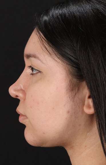 Chin Implant Before & After Patient #1604