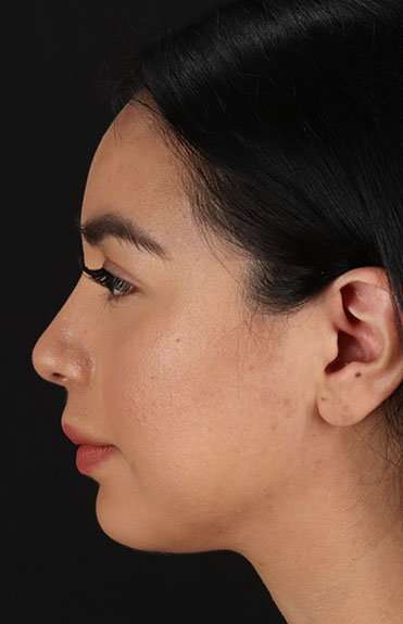 Chin Implant Before & After Patient #1626