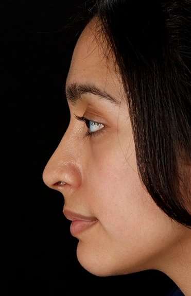 Chin Implant Before & After Patient #1637