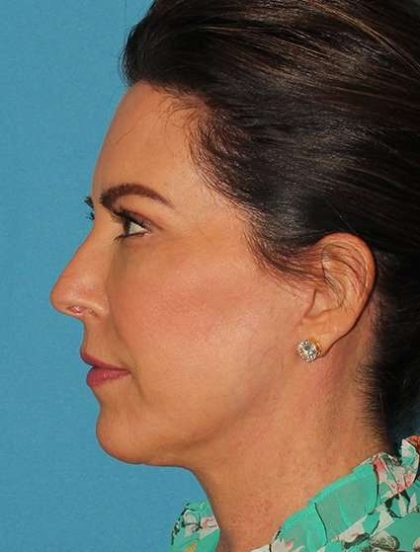 Chin Implant Before & After Patient #1659