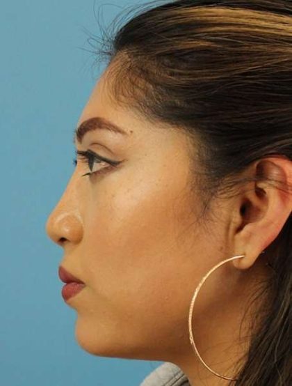 Chin Implant Before & After Patient #1670
