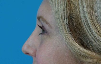 Eyelid Lift Before & After Patient #1747