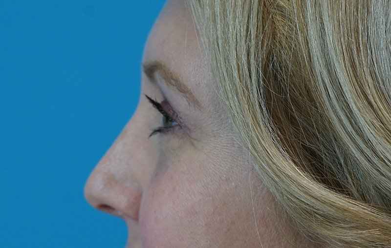 Eyelid Lift Before & After Patient #1747