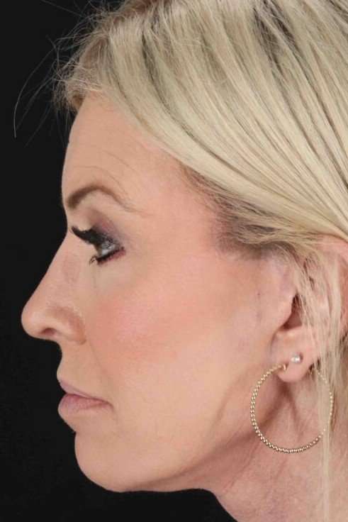 Facelift Before & After Patient #1767