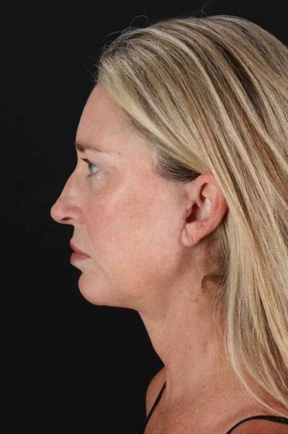 Facelift Before & After Patient #1778